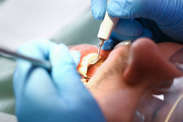 Best Broken or Cracked Tooth Emergency Dentist in Placitas, NM